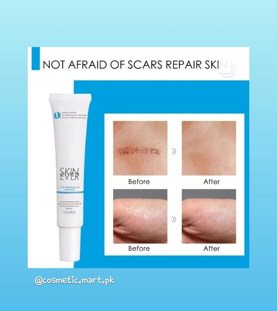 Skin Ever Herbal Scars Removal Gel Ointment