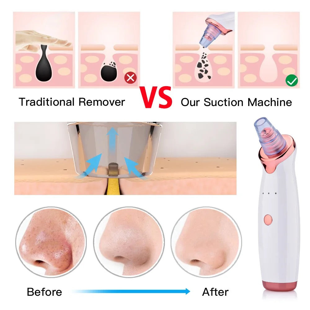 Blackhead Vacuum Pore Cleaner Blackhead Remover